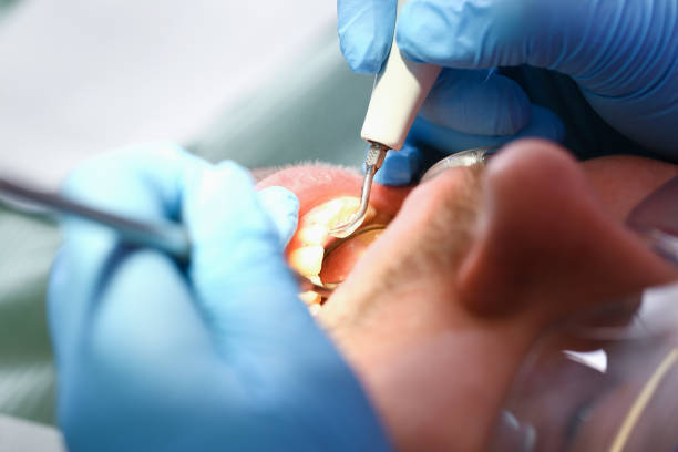 Best Chipped Tooth Repair Near Me  in Junction City, KY